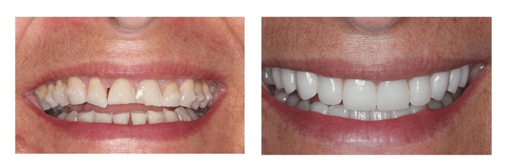 Before and After image of Smile Makeover in Fort Lauderdale Area